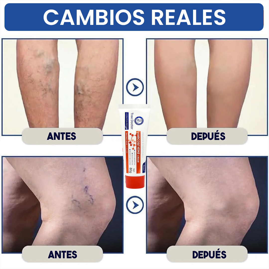 Crema Tratamiento para Venas – Tree Doctor