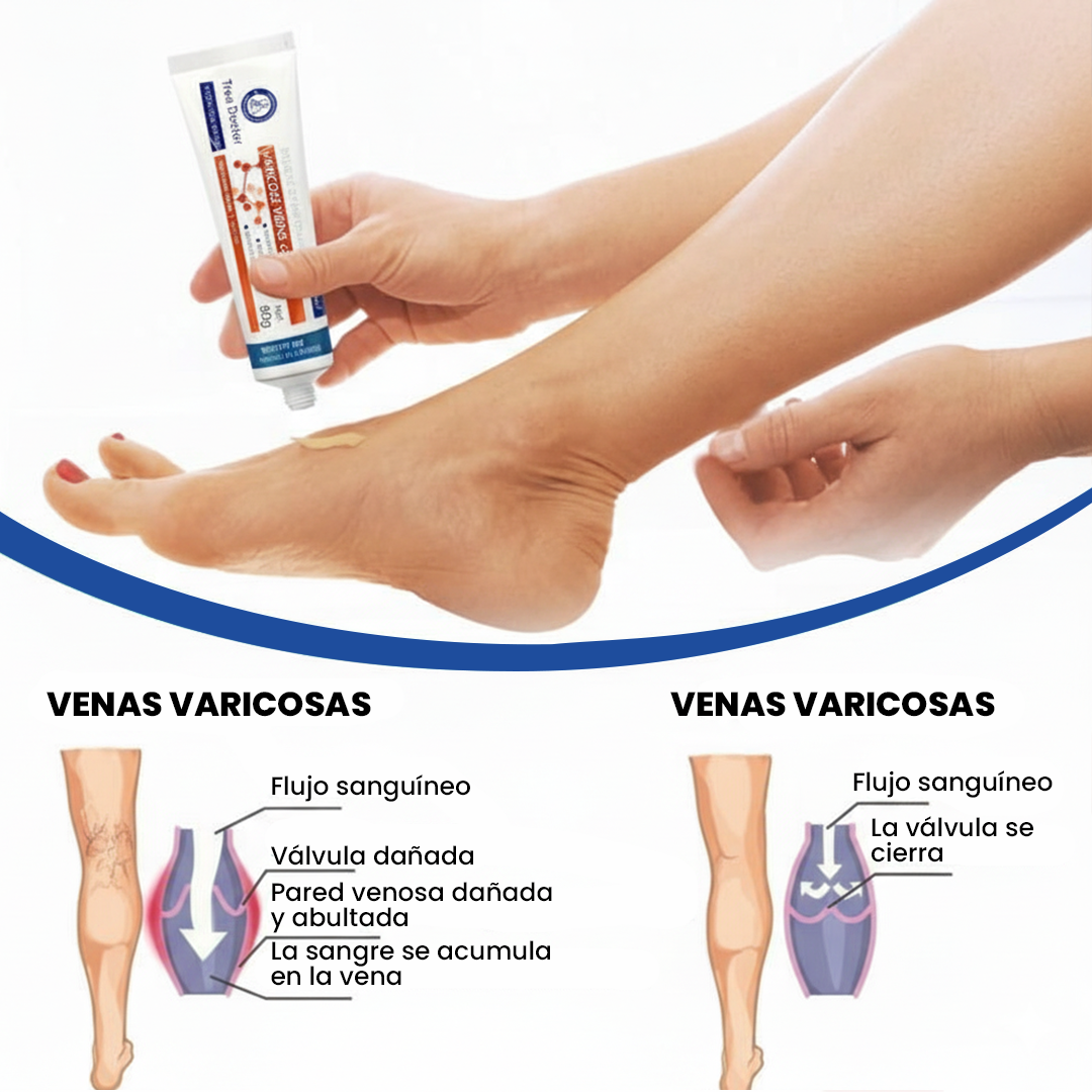 Crema Tratamiento para Venas – Tree Doctor